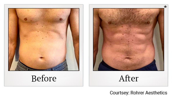 Results 2 of bodytone treatment at True Form Medical Group in Oakland and Fremont