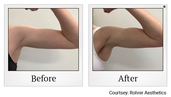 Results 3 of bodytone treatment at True Form Medical Group in Oakland and Fremont