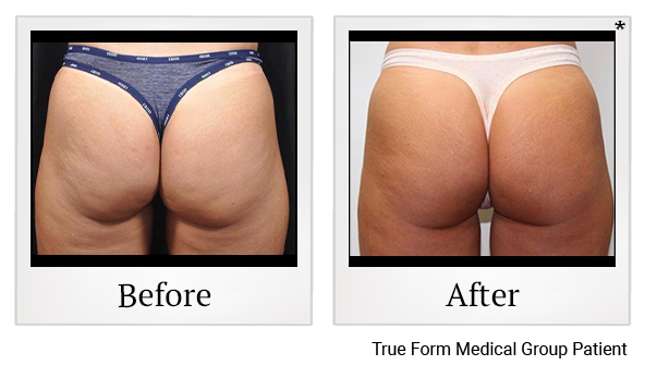 Results 88 of emsculpt treatment at True Form Medical Group in Oakland and Fremont