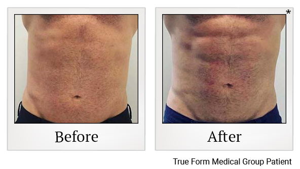 Results 90 of emsculpt treatment at True Form Medical Group in Oakland and Fremont