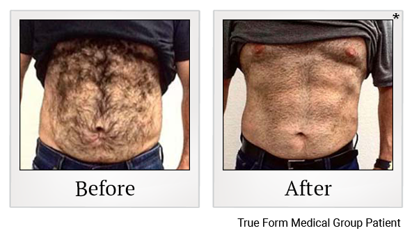 Results 93 of emsculpt treatment at True Form Medical Group in Oakland and Fremont