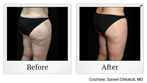 Exilis results 2 at True Form Medical Group in Oakland and Fremont