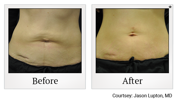 Results 20 of exilis ultra treatment at True Form Medical Group in Oakland and Fremont