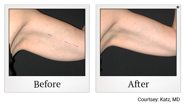 Results 28 of exilis ultra treatment at True Form Medical Group in Oakland and Fremont