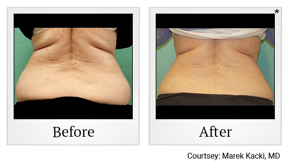 Results 31 of exilis ultra treatment at True Form Medical Group in Oakland and Fremont