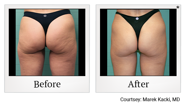 Results 33 of exilis ultra treatment at True Form Medical Group in Oakland and Fremont