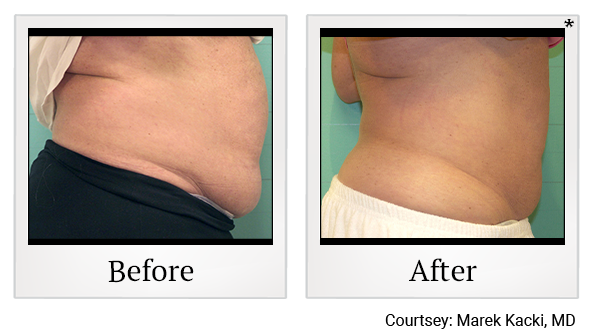 Results 34 of exilis ultra treatment at True Form Medical Group in Oakland and Fremont