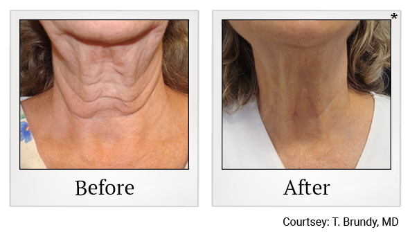 Exilis results 3 at True Form Medical Group in Oakland and Fremont