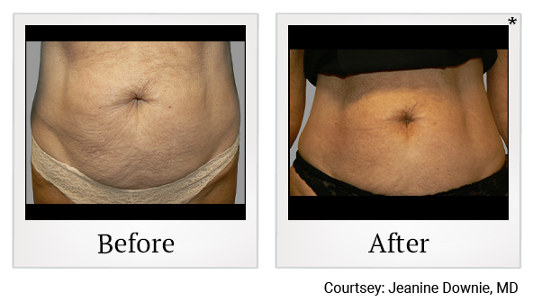 Exilis results 1 at True Form Medical Group in Oakland and Fremont