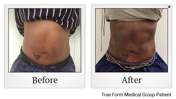 Results 3 of exilis ultra treatment at True Form Medical Group in Oakland and Fremont