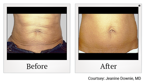 Results 8 of exilis ultra treatment at True Form Medical Group in Oakland and Fremont