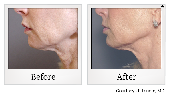 Results 9 of exilis ultra treatment at True Form Medical Group in Oakland and Fremont