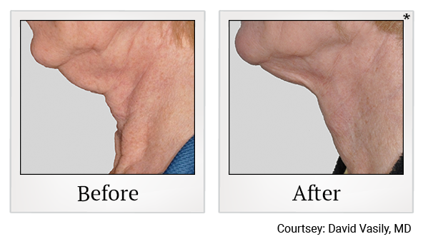 Results 10 of exilis ultra treatment at True Form Medical Group in Oakland and Fremont