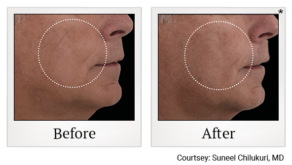 Results 12 of EmFace treatment at True Form Medical Group in Oakland and Fremont