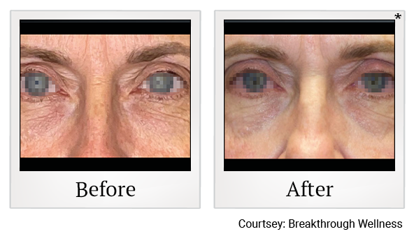 Results 24 of EmFace treatment at True Form Medical Group in Oakland and Fremont