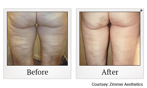 Results 2 of Zwave treatment at True Form Medical Group in Oakland and Fremont