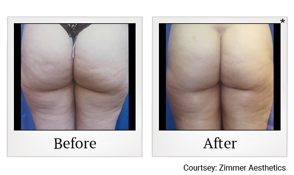 Results 5 of Zwave treatment at True Form Medical Group in Oakland and Fremont