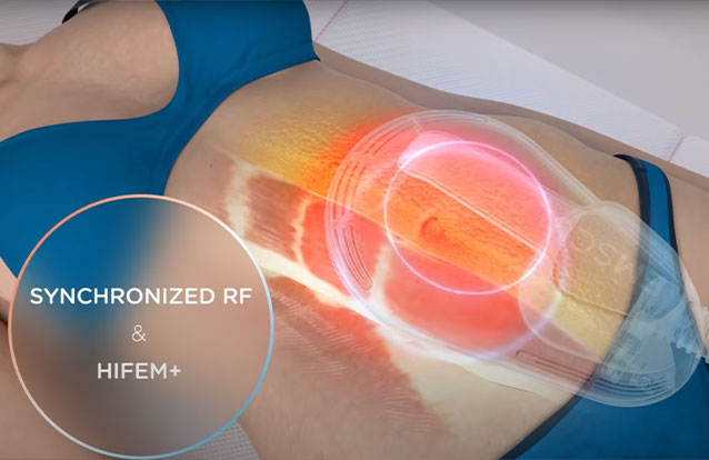 How Emsculpt NEO works at True Form Medical Group in Oakland and Fremont