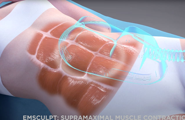 How Emsculpt works at True Form Medical Group in Oakland and Fremont