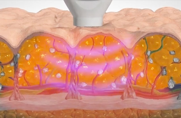 How Emtone works at True Form Medical Group in Oakland and Fremont