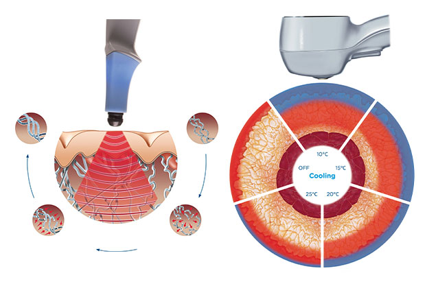 How Exilis Ultra works at True Form Medical Group in Oakland and Fremont